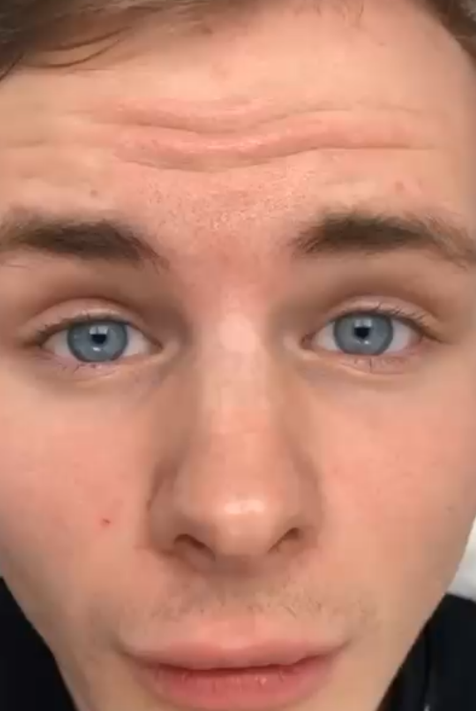 Anti-Wrinkle Treatment in Liverpool