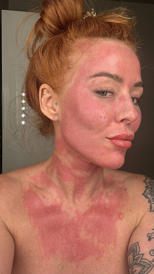 Chemical Peel Treatment in Liverpool