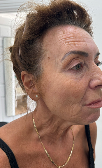 Dermal Filler Treatment in Liverpool