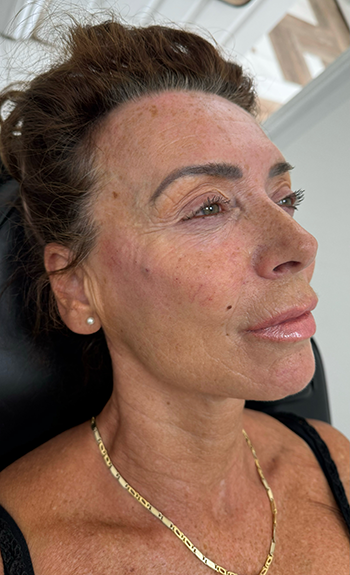 Dermal Filler Treatment in Liverpool
