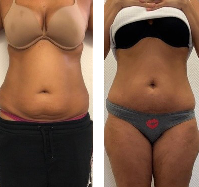 Emsculpt Treatment in Liverpool