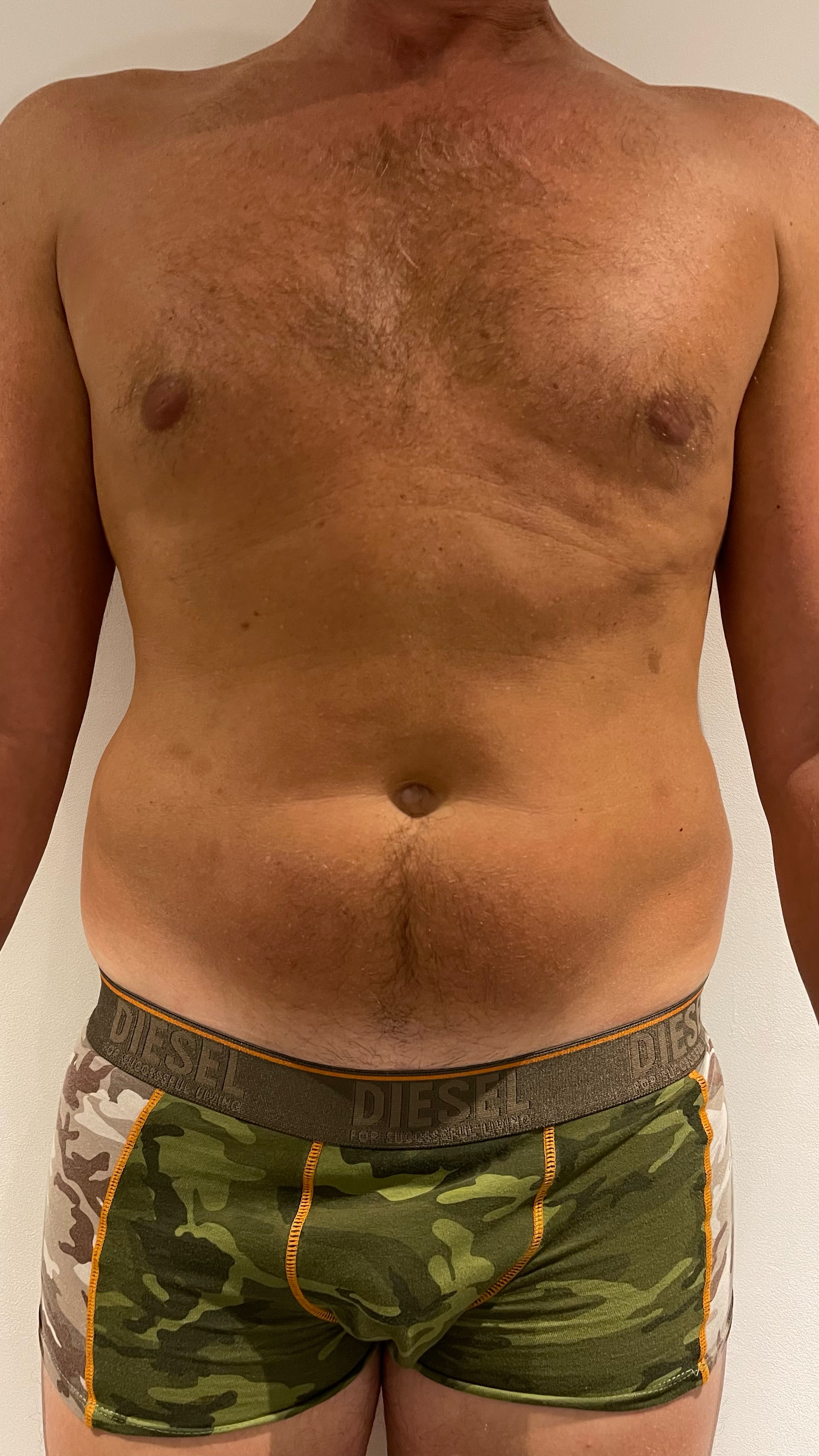 Fat Disolving Treatment in Liverpool