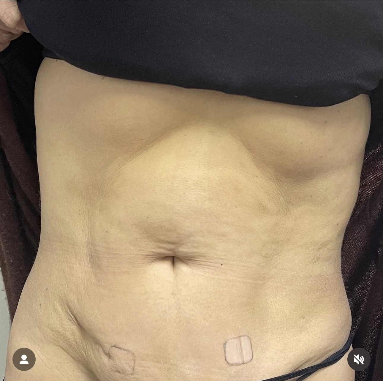Fat Disolving Treatment in Liverpool