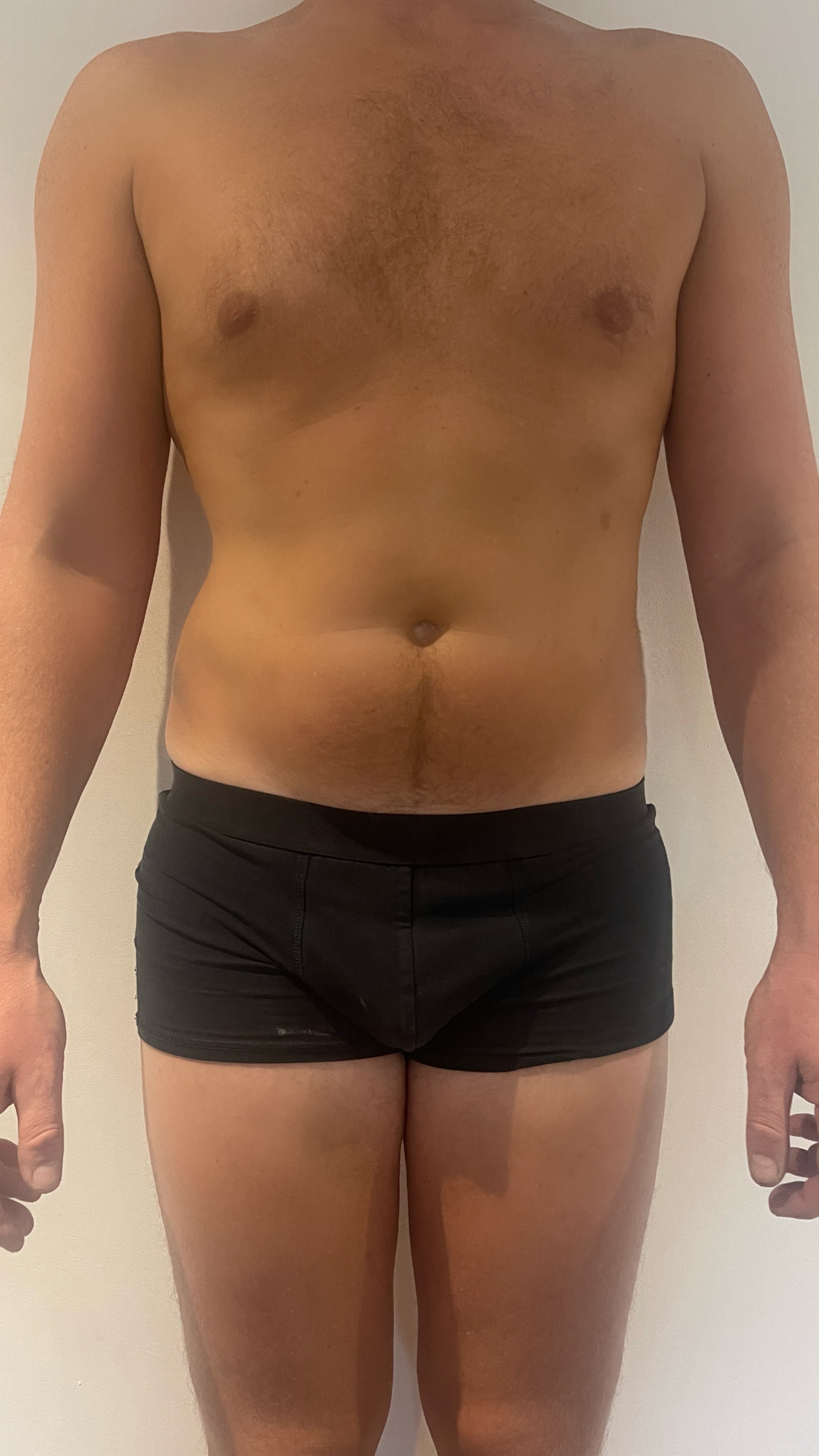 Fat Disolving Treatment in Liverpool