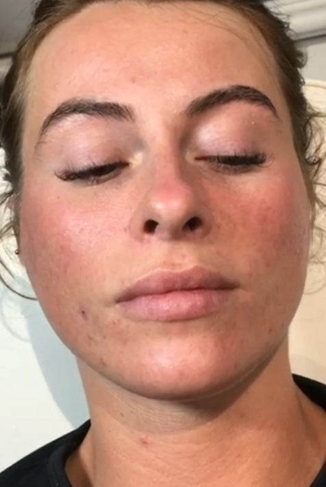 Hifu Treatment in Liverpool