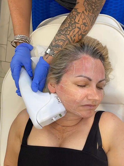 Hifu Treatment in Liverpool
