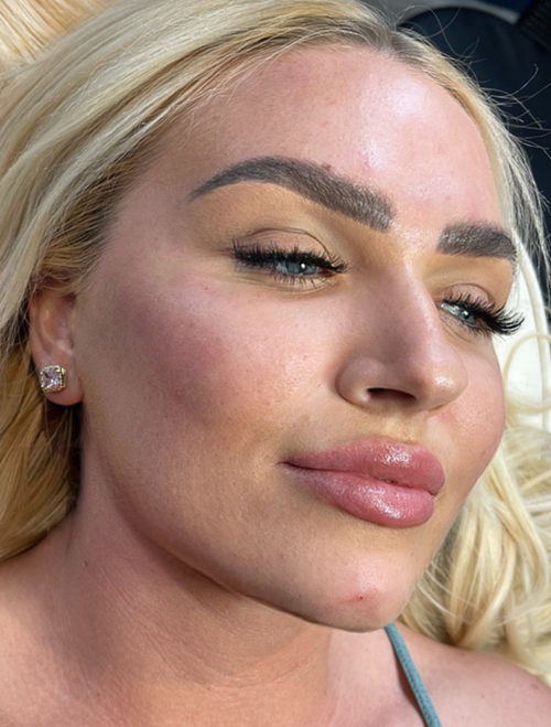 Mesotherapy Treatment in Liverpool