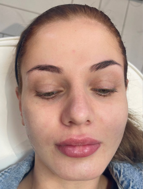 Microneedling Treatment in Liverpool
