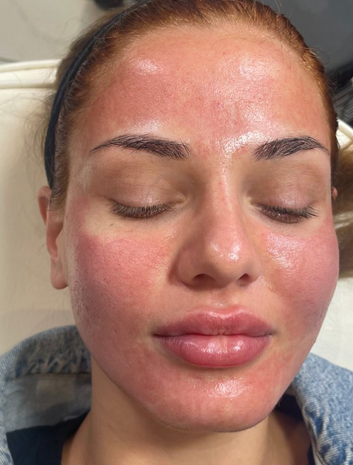 Microneedling Treatment in Liverpool