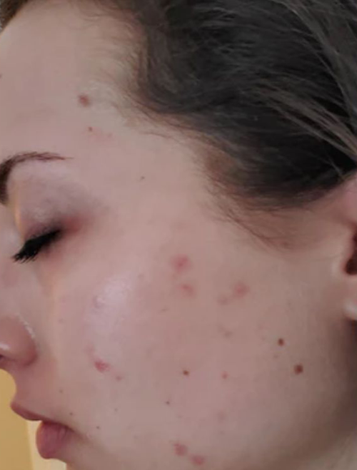 Microneedling Treatment in Liverpool
