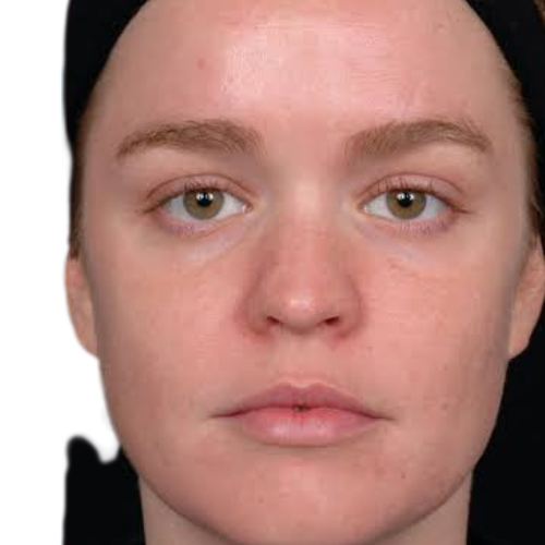 Dermal Fillers Treatment in Liverpool