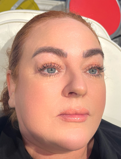 Mesotherapy Treatment in Liverpool