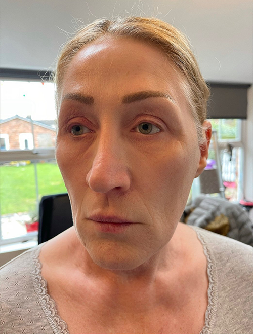 Profhilo Treatments Liverpool