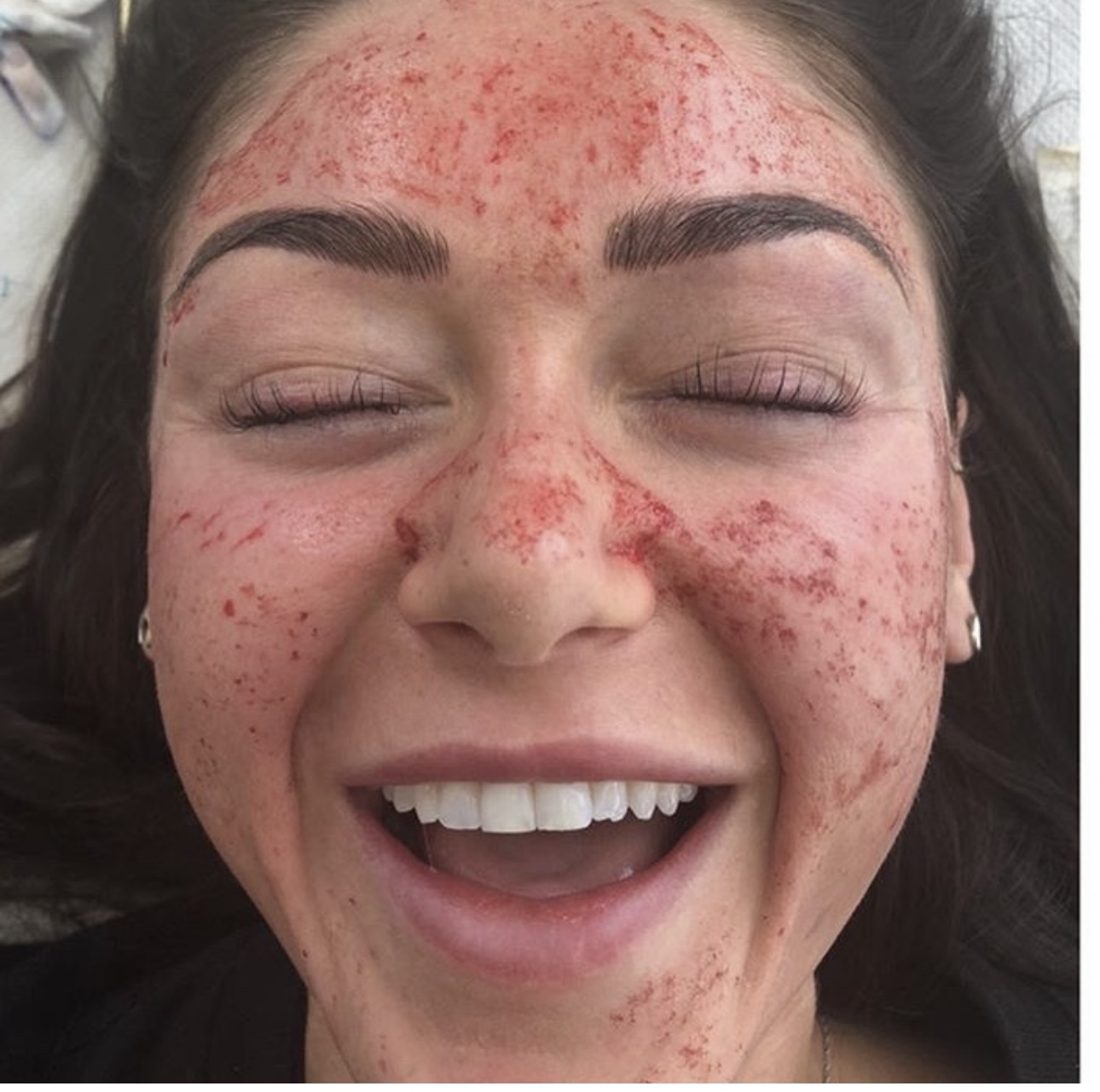 PRP Treatment in Liverpool