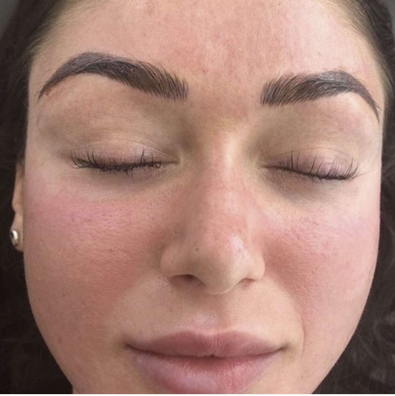 PRP Treatment in Liverpool