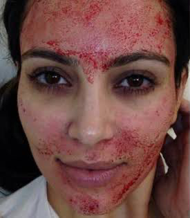 PRP Treatment in Liverpool