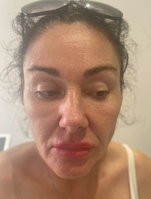 Sculptra Treatments Liverpool