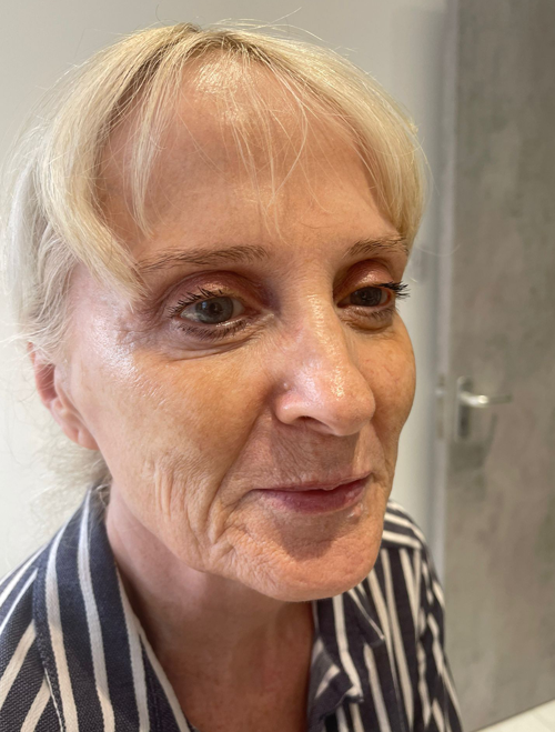 Sculptra Treatments Liverpool