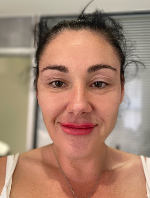 Sculptra Treatments Liverpool