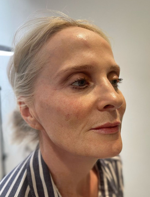 Sculptra Treatments Liverpool