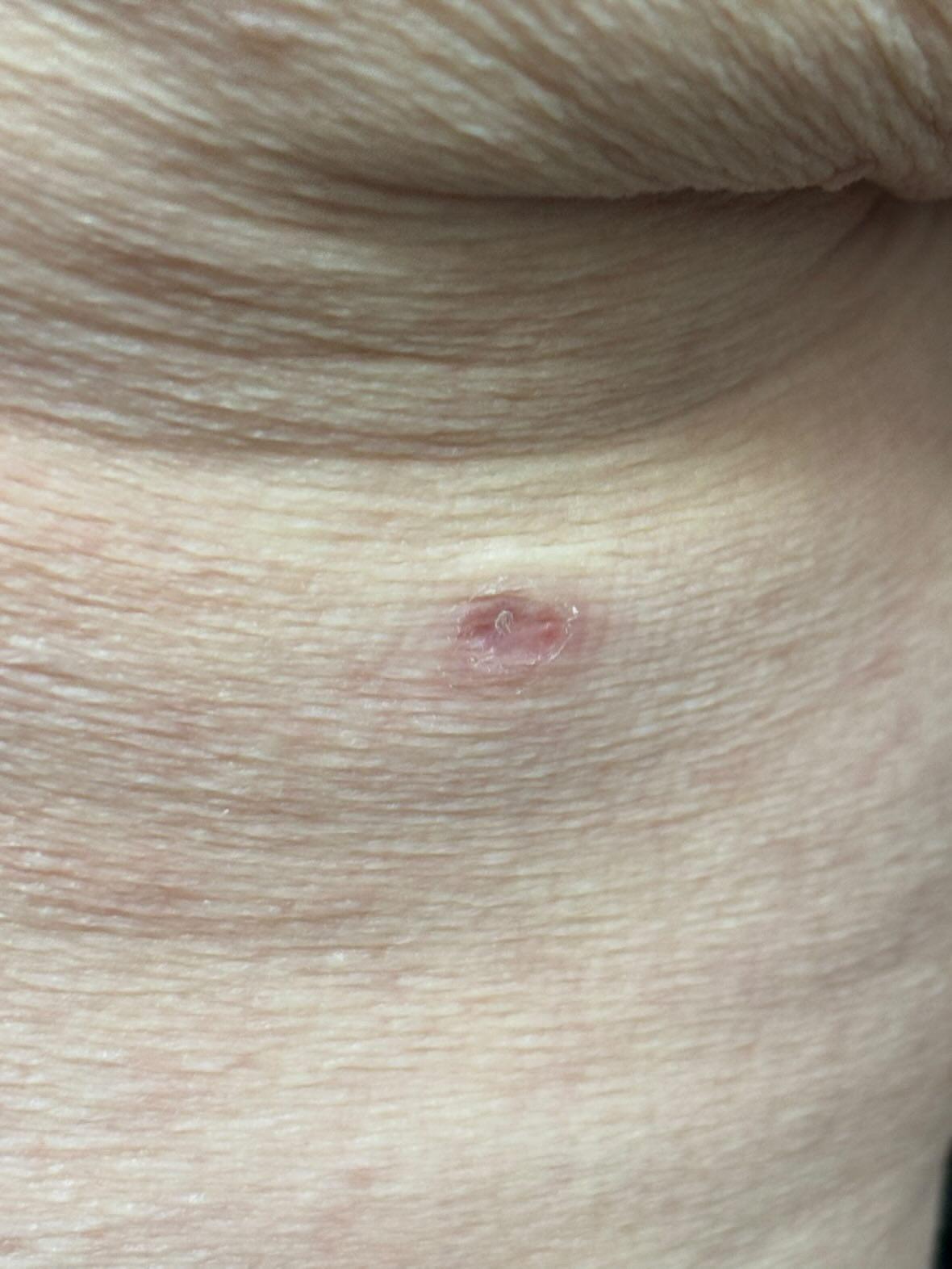 Skin Tag Removal Treatment in Liverpool