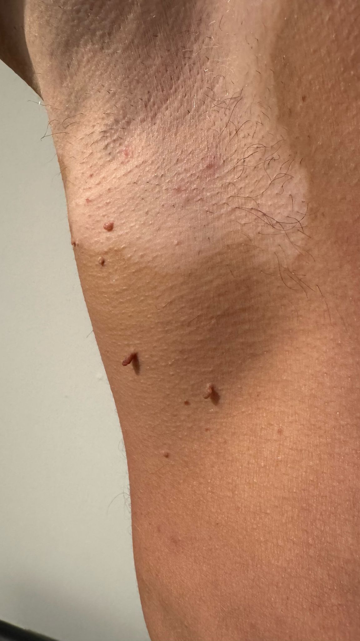 Skin Tag Removal Treatment in Liverpool