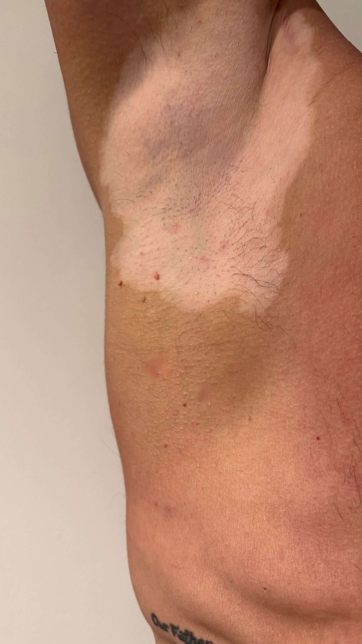 Skin Tag Removal Treatment in Liverpool
