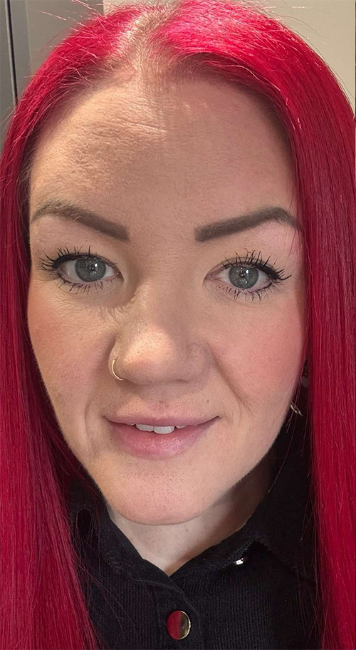 Dermal Fillers Treatment in Liverpool