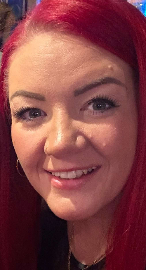 Dermal Fillers Treatment in Liverpool