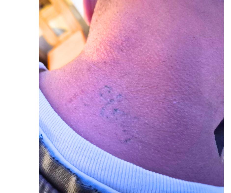 Laser Tattoo Removal in Liverpool