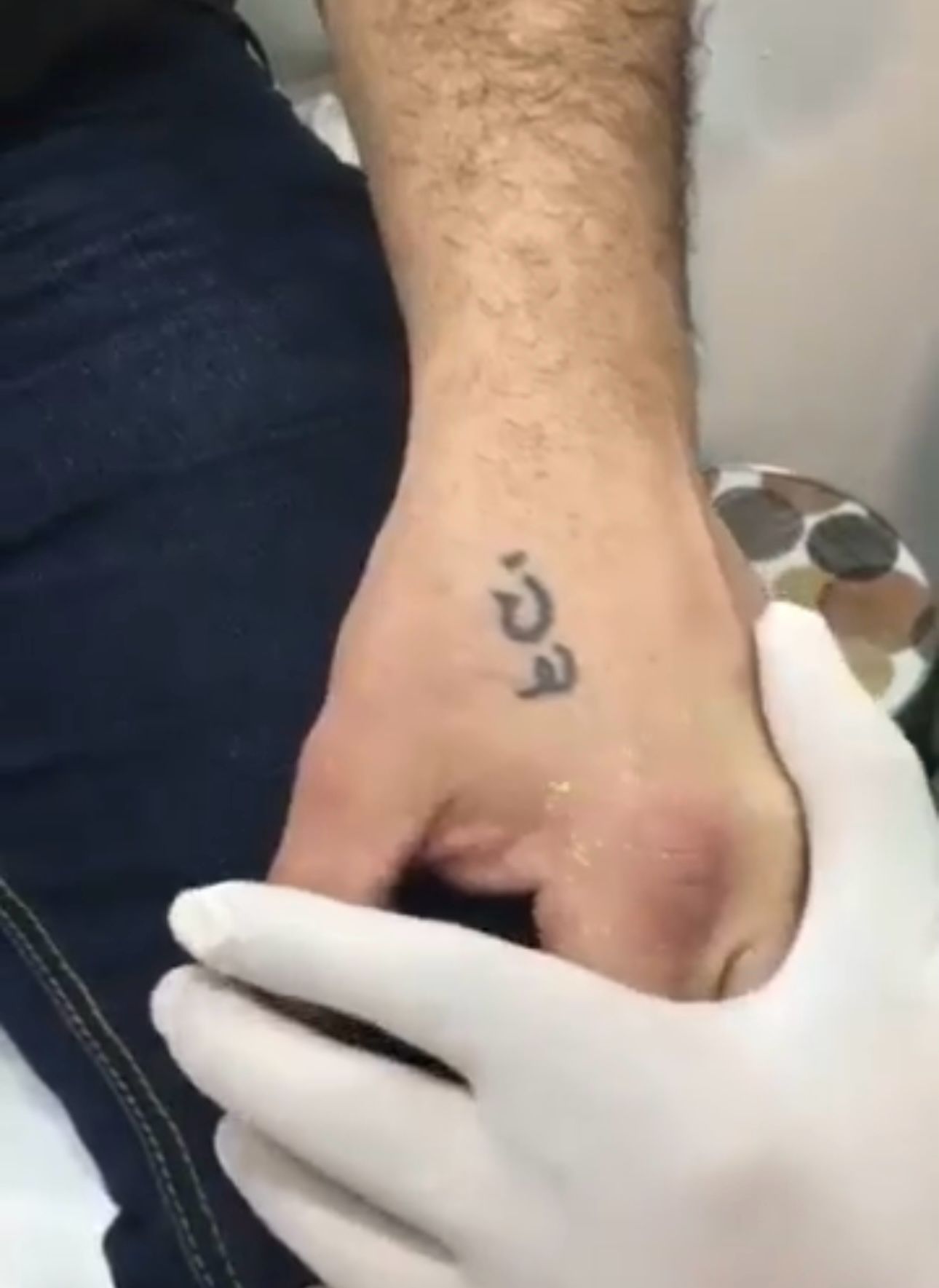 Laser Tattoo Removal in Liverpool