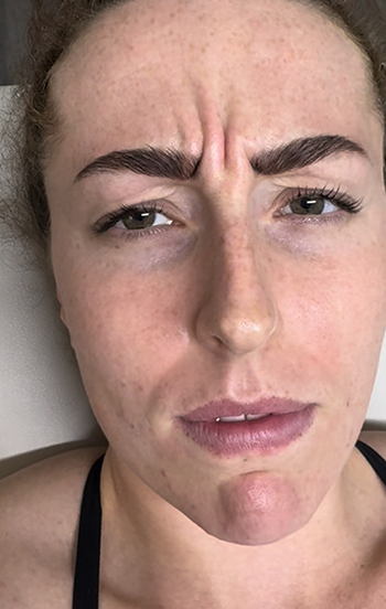 Anti-Wrinkle Treatment in Liverpool