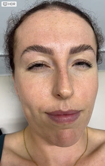 Anti-Wrinkle Treatment in Liverpool